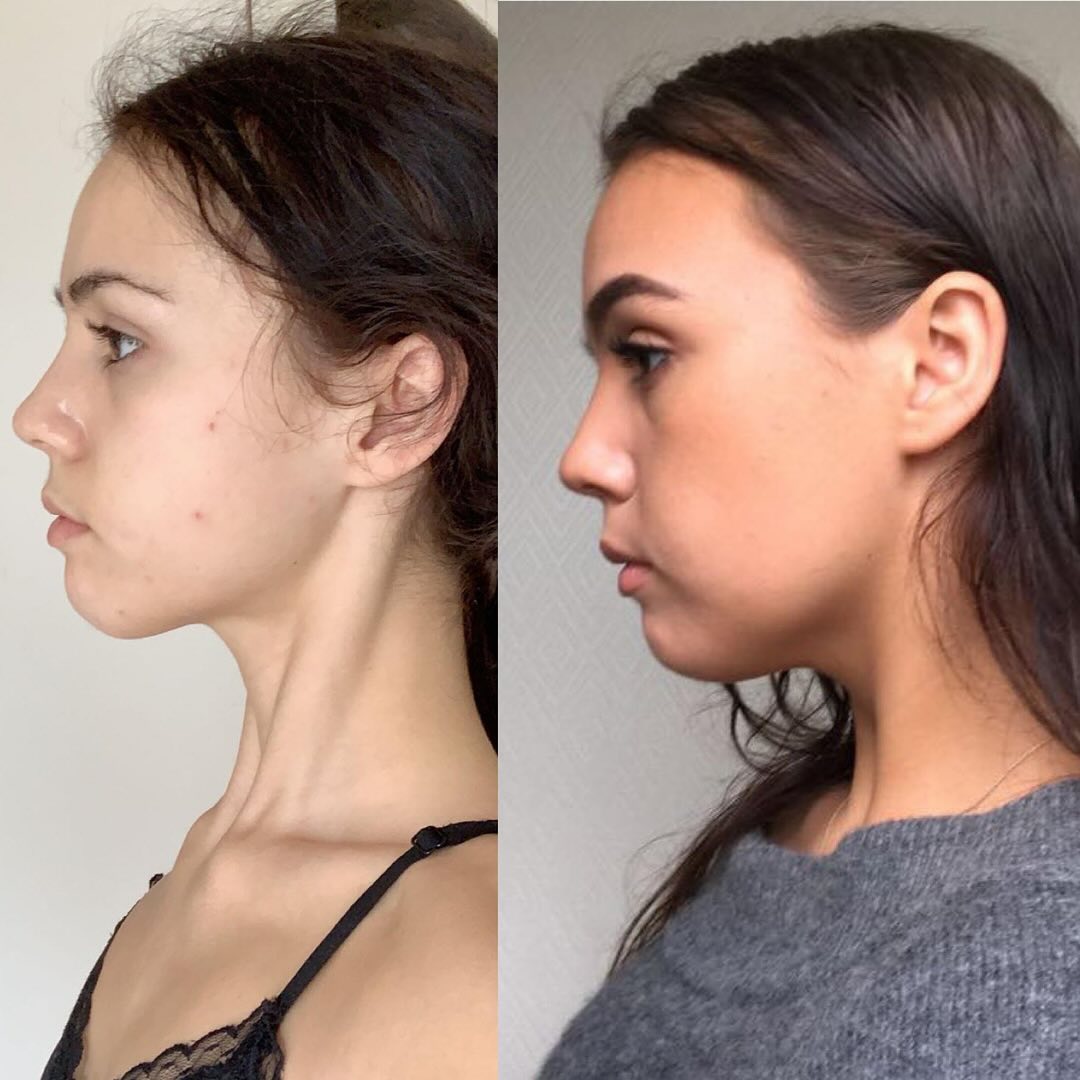 Real customer before and after side by side, female side profile, sharper jaw and clearer skin.