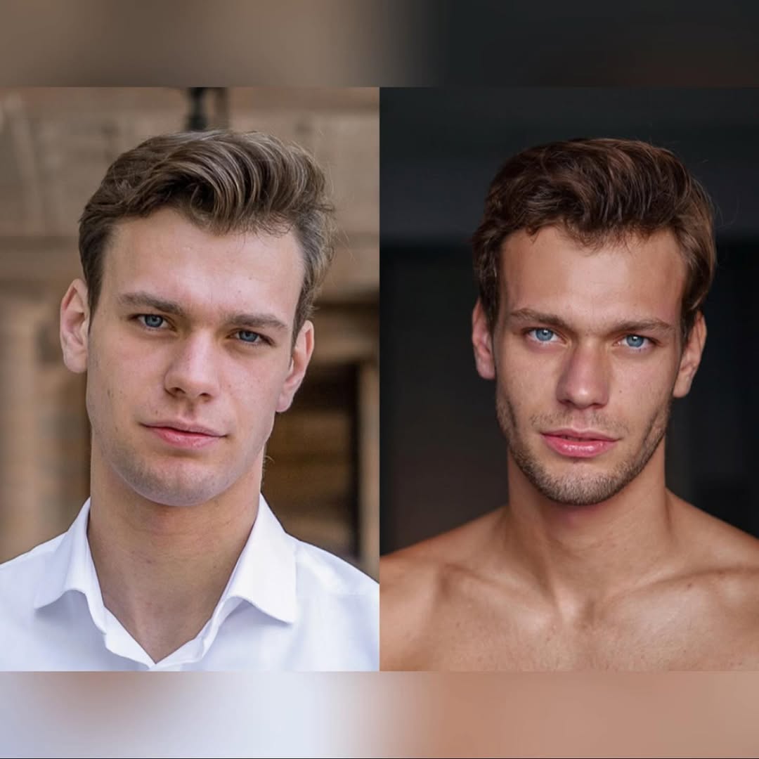 Real customer before and after side by side, front view, sharper jawline after 60 days.