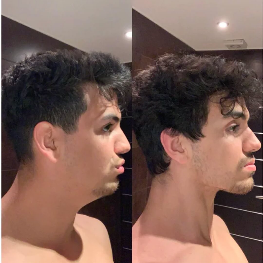 Real customer before and after side by side, side profile, more defined jawline.